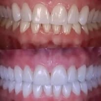 Blanchiment dentaire - Cas 4